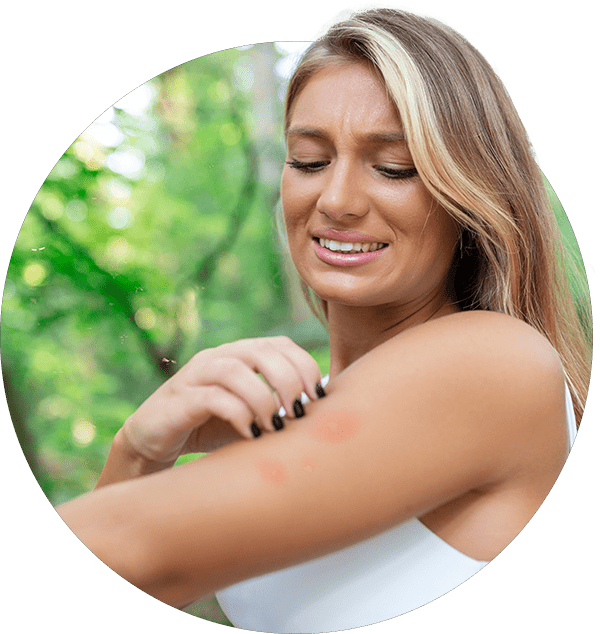 itchy mosquito bite irritated young woman scratching her itching arm